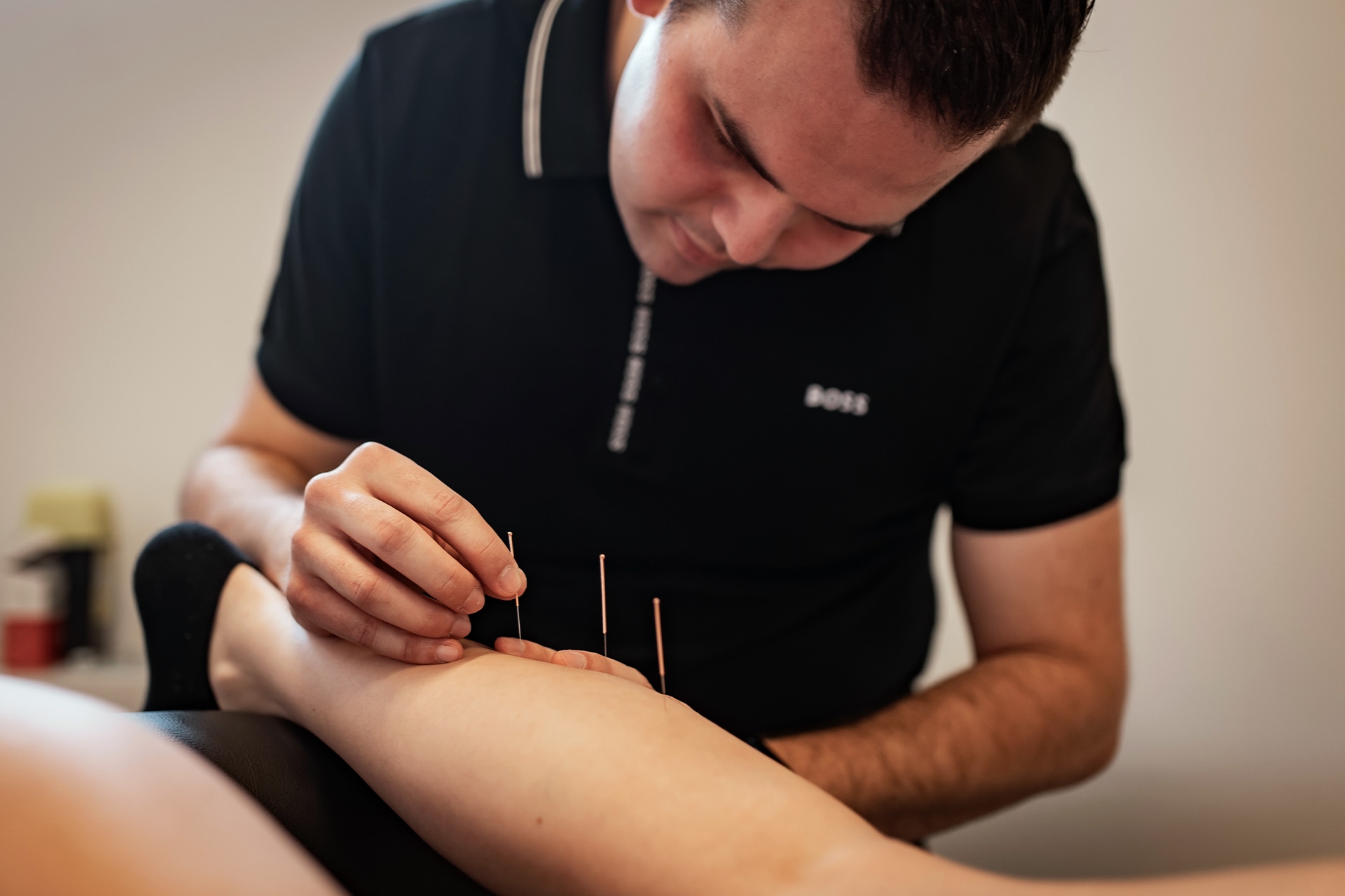 Dry needling